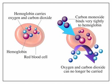 Decompression Sickness