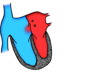 Foramen Oval